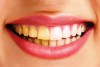 ❌ 5  nguyên nhân khiến răng bị ngả màu vàng
