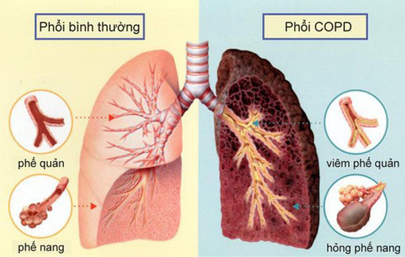 Thuốc lá "đốt" lá phổi như thế nào?