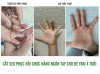 Cắt sẹo phục hồi chức năng ngón tay cho bé trai