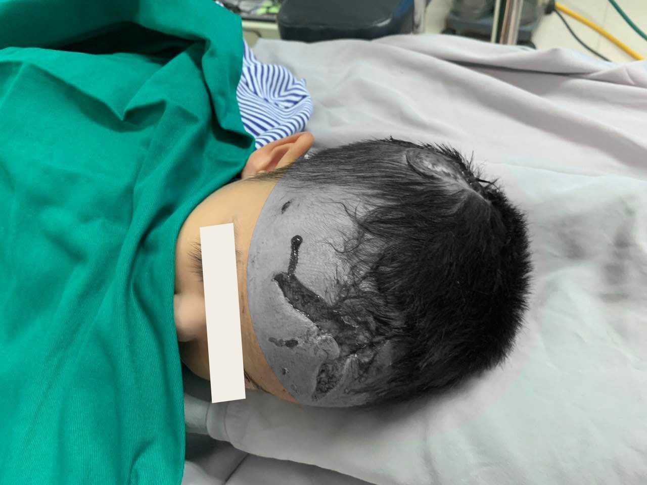 Bất ngờ bị chó nhà tấn công, bé trai 23 tháng tuổi phải nhập viện với nhiều vết thương vùng đầu, mặt